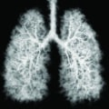 Illustration of a toxic smoke in Lung